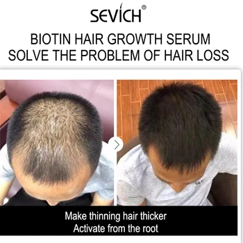 Sevich Day & Night Plaukų Augimą Purškimo Biotinas Plaukų Augimo eterinis Aliejus Kovos su Plaukų Slinkimas Gydymo Vyrai Moterys Imbieras Augti Plaukai 3
